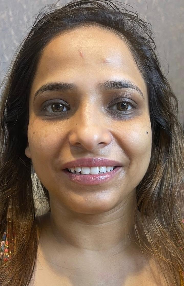 After — Skin Care Treatment